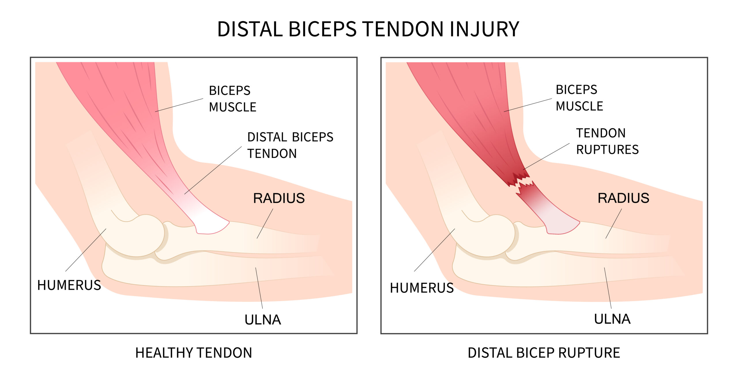 Ruptured Biceps or Triceps Tendon - Golden State Orthopedics & Spine