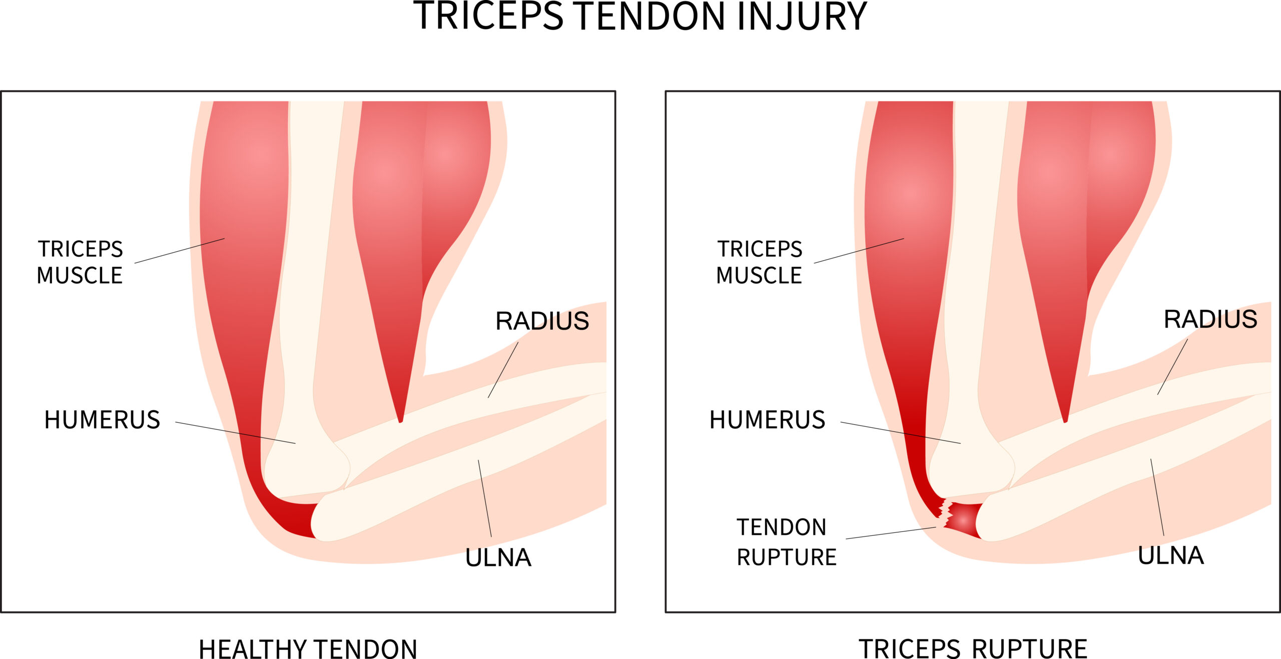 Bicep/Tricep Tendonitis: Causes, Symptoms And Treatment - AIRROSTI