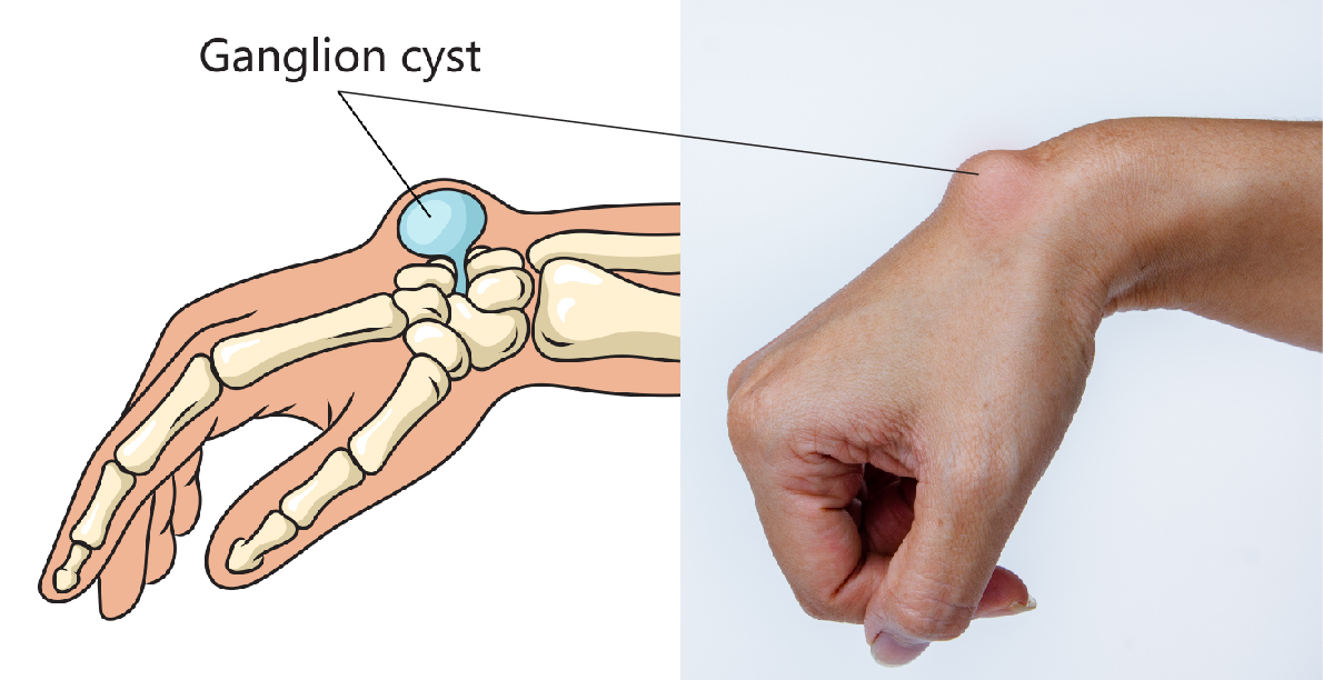 Ganglion And Mucous Cysts Golden State Orthopedics Spine