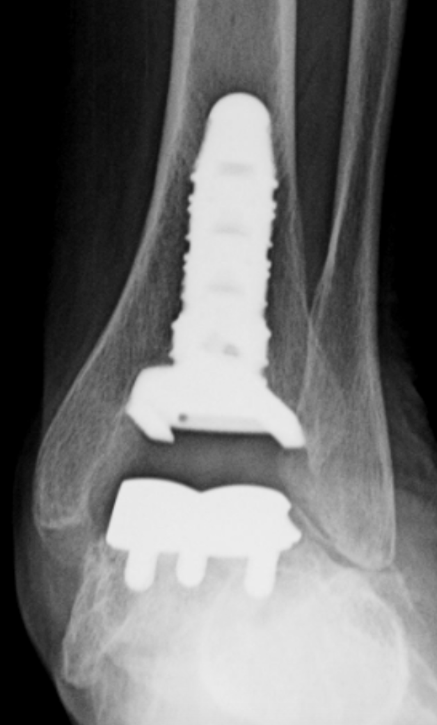 An x-ray of a person 's ankle with a screw in it