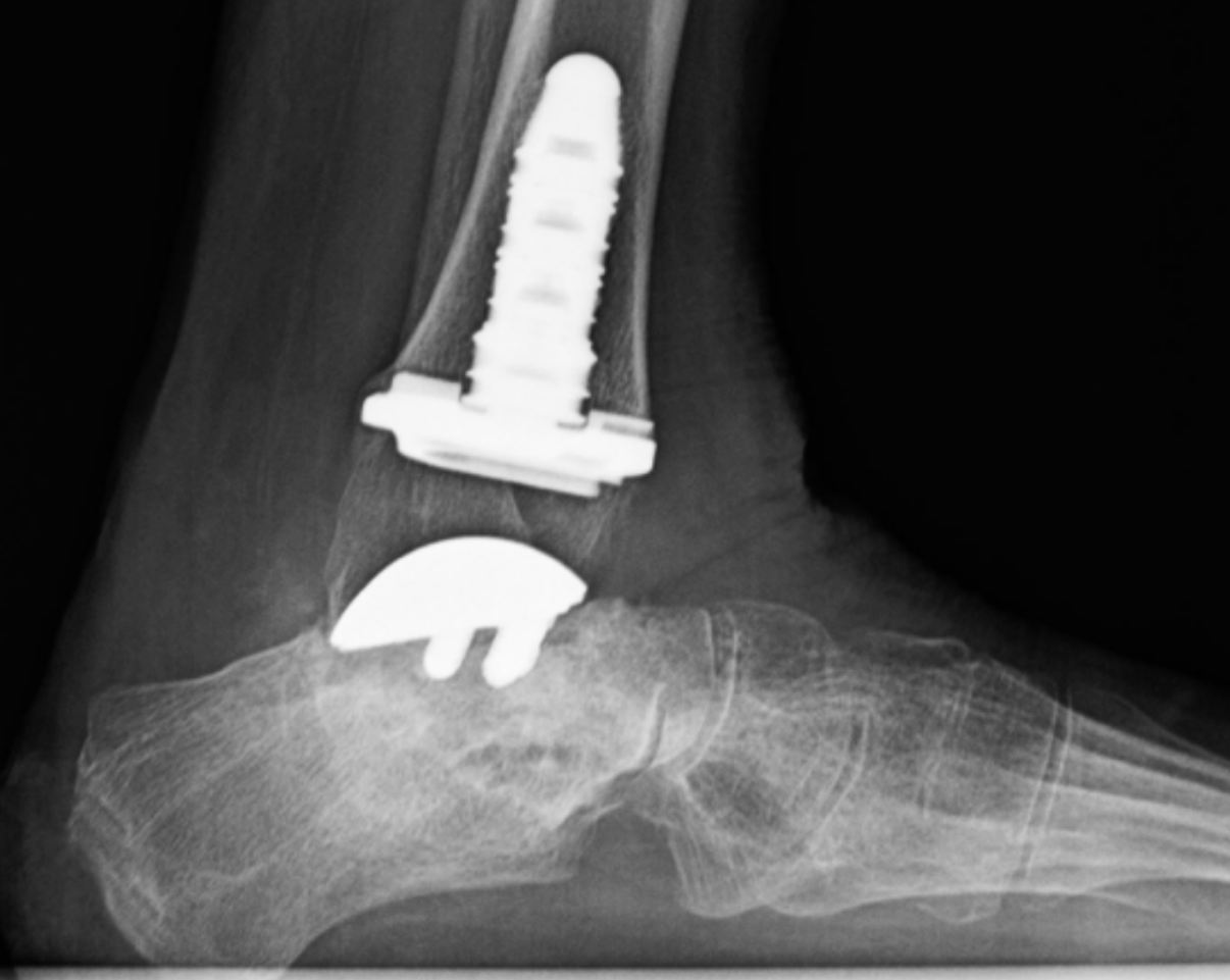 An x-ray of an ankle with a screw in it