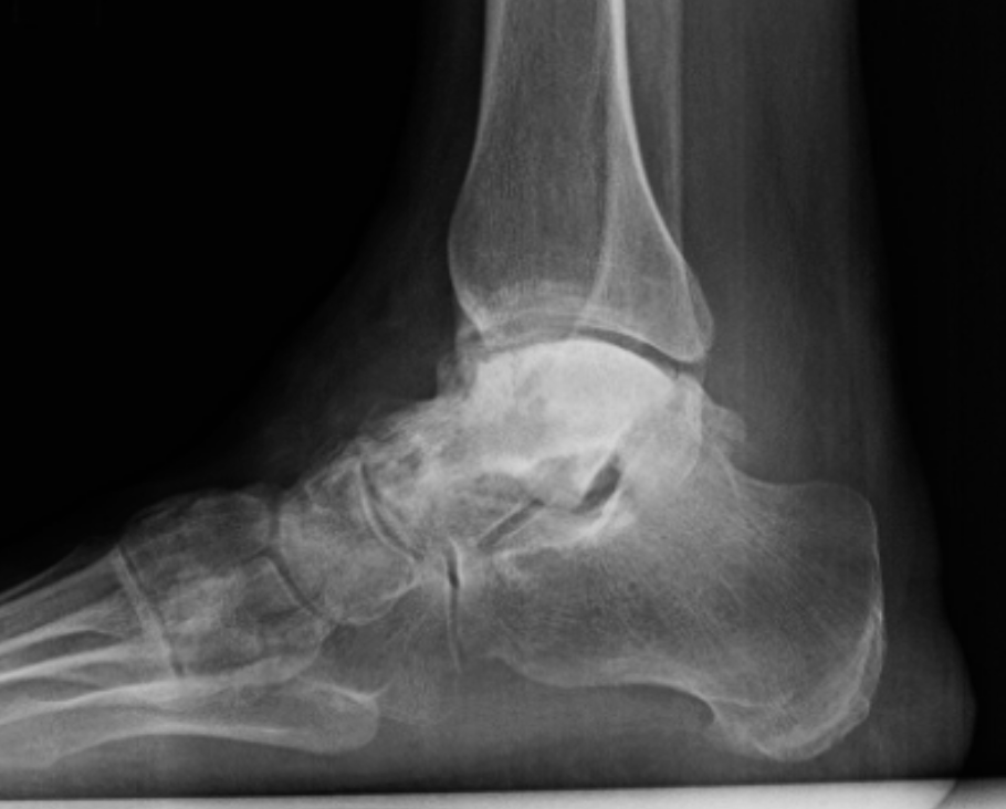 A black and white x-ray of a person 's foot