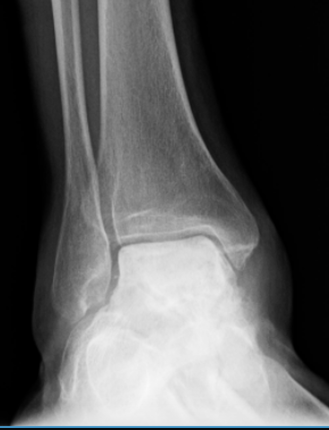 A black and white x-ray of a person 's ankle