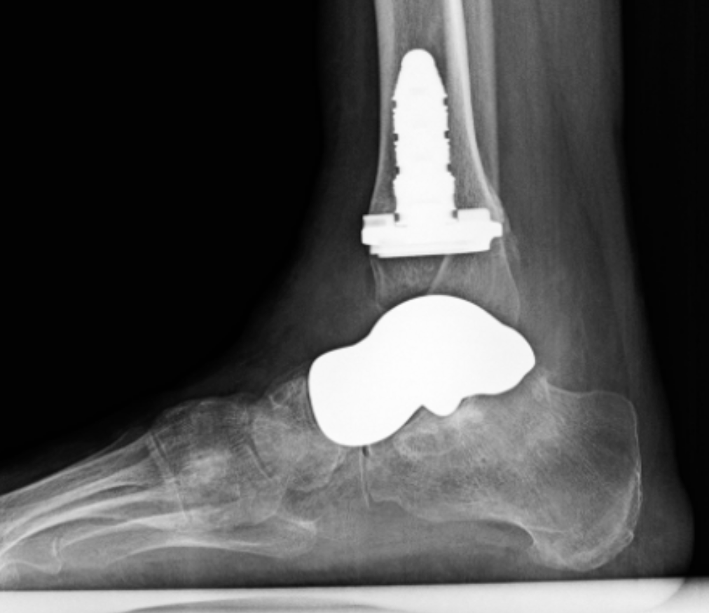 An x-ray of a foot with a screw in it