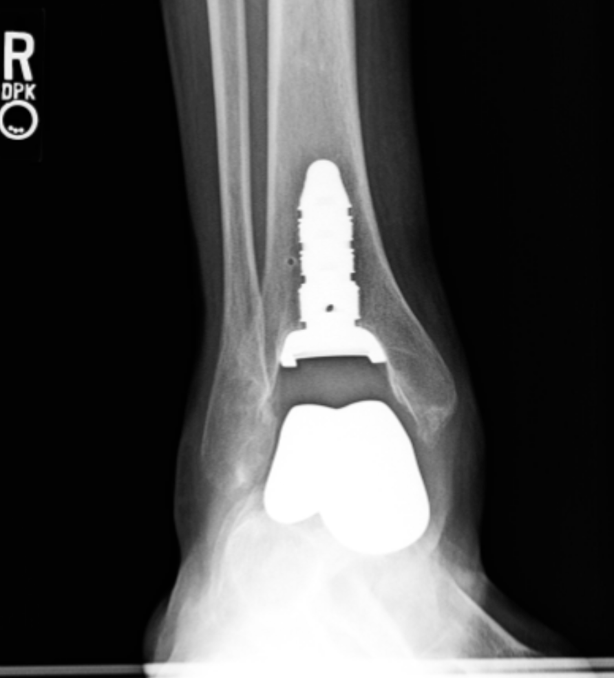 An x-ray of a person 's ankle with the letter r on it